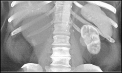 High Density Renal Cyst - CTisus CT Scan