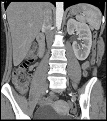 Small Renal Calculi Seen on Arterial Phase Images - CTisus CT Scan
