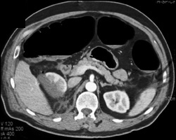 Renal Laceration - CTisus CT Scan