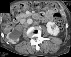 Transitional Cell Cancer (TCC) Right Renal Pelvis - CTisus CT Scan