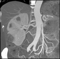 Renal Cell Carcinoma - CTisus CT Scan