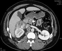Renal Abscess - CTisus CT Scan