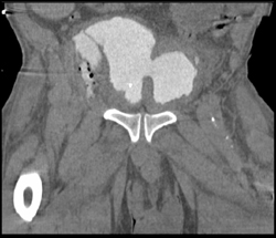 Bladder Perforation on CT Urogram - CTisus CT Scan