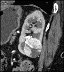 Renal Cell Carcinoma - CTisus CT Scan
