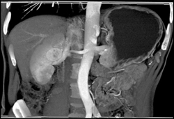 Renal Cell Carcinoma - CTisus CT Scan
