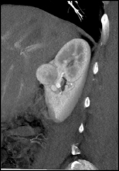 Renal Cell Carcinoma - CTisus CT Scan