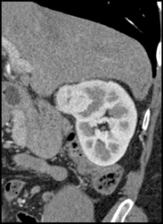 Renal Cell Carcinoma - CTisus CT Scan