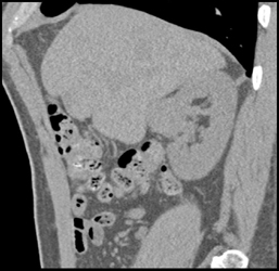 Renal Cell Carcinoma - CTisus CT Scan