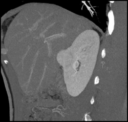 Renal Cell Carcinoma - CTisus CT Scan