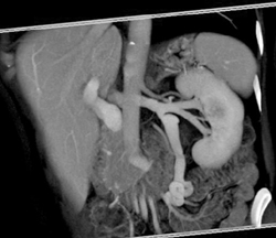 Prominent Left Gonadal Vein - CTisus CT Scan