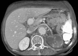 Left Renal Infarction - CTisus CT Scan