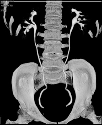 Normal CT Urogram - CTisus CT Scan