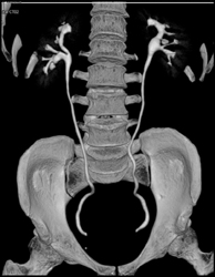 Normal CT Urogram - CTisus CT Scan