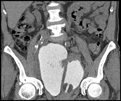 Walled Off Leak From Bladder Perforation - CTisus CT Scan