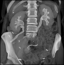 Ileal Loop With Enhanced 3D - CTisus CT Scan