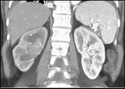 Transitional Cell Carcinoma of the Left Kidney - CTisus CT Scan