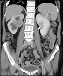 Transitional Cell Carcinoma of the Left Kidney - CTisus CT Scan
