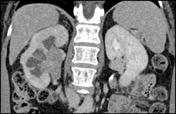 Transitional Cell Carcinoma of the Left Kidney - CTisus CT Scan