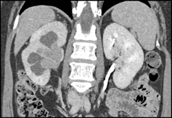 Transitional Cell Carcinoma of the Left Kidney - CTisus CT Scan
