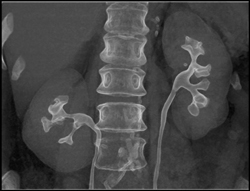 Normal CT Urogram - CTisus CT Scan