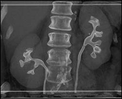 Normal CT Urogram - CTisus CT Scan