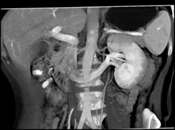 Retroaortic Component of Renal Vein - CTisus CT Scan