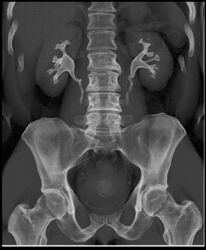 Normal CT Urogram - CTisus CT Scan