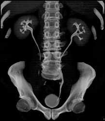 Normal CT Urogram - CTisus CT Scan