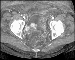 Bladder Cancer - CTisus CT Scan