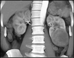 Renal Cell Carcinoma - CTisus CT Scan