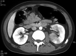 Acute Pyelonephritis - CTisus CT Scan