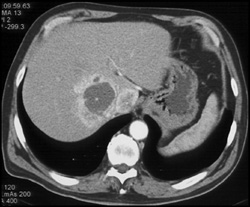 Adrenal Carcinoma Invades Liver - CTisus CT Scan