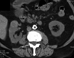 Renal Cell Carcinoma - CTisus CT Scan