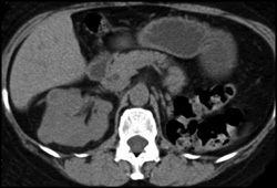 Multiple Right Renal Cell Carcinomas - CTisus CT Scan