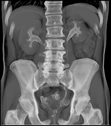 Bladder Cancer - CTisus CT Scan
