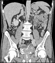 Bladder Cancer - CTisus CT Scan