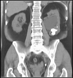 Parapelvic Cyst - CTisus CT Scan