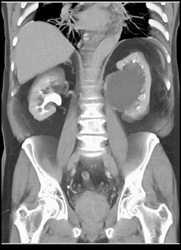 Extrarenal Pelvis - CTisus CT Scan