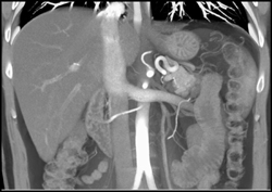 Multiple Right Renal Arteries - CTisus CT Scan