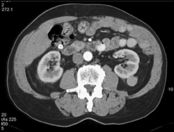 Solid Left Renal Mass - CTisus CT Scan