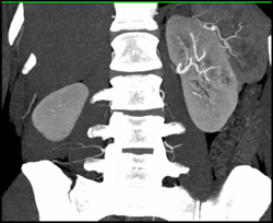 Subtle Left Renal Cell Carcinoma - CTisus CT Scan