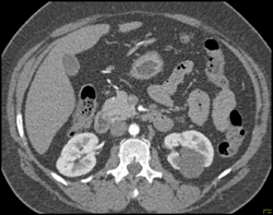 Renal Cyst-bosniak 2 - CTisus CT Scan