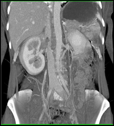 Clot in Renal Vein Extends Into IVC - CTisus CT Scan