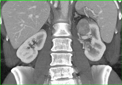 Renal Cell Carcinoma - CTisus CT Scan
