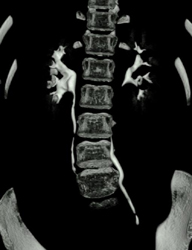 Normal CT Urogram - CTisus CT Scan