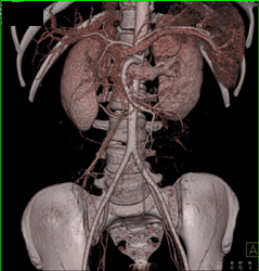 CTA on A 64 Slice MDCT in A Child - CTisus CT Scan
