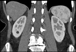 Angiomyolipoma (AML) on Right and Atypical AML on Left-prior Bleed - CTisus CT Scan