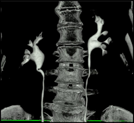 Normal CT Urogram - CTisus CT Scan
