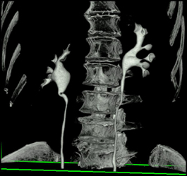 Normal CT Urogram - CTisus CT Scan
