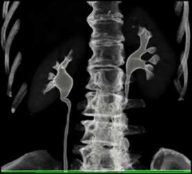 Normal CT Urogram - CTisus CT Scan